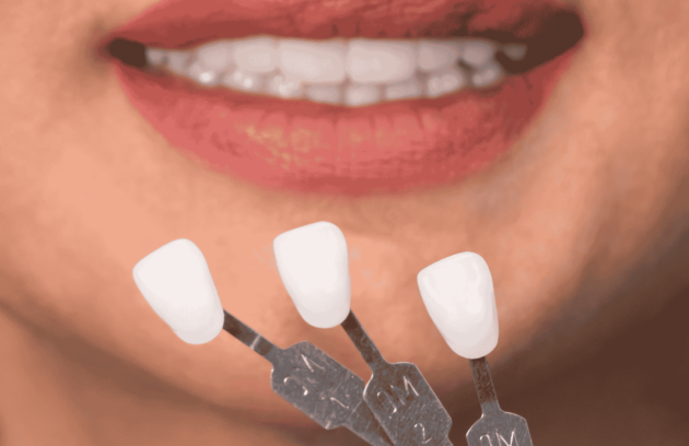 composite veneers