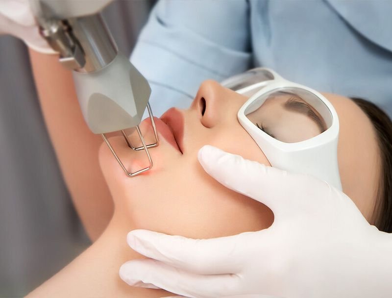 إزالة الندوب بالليزر