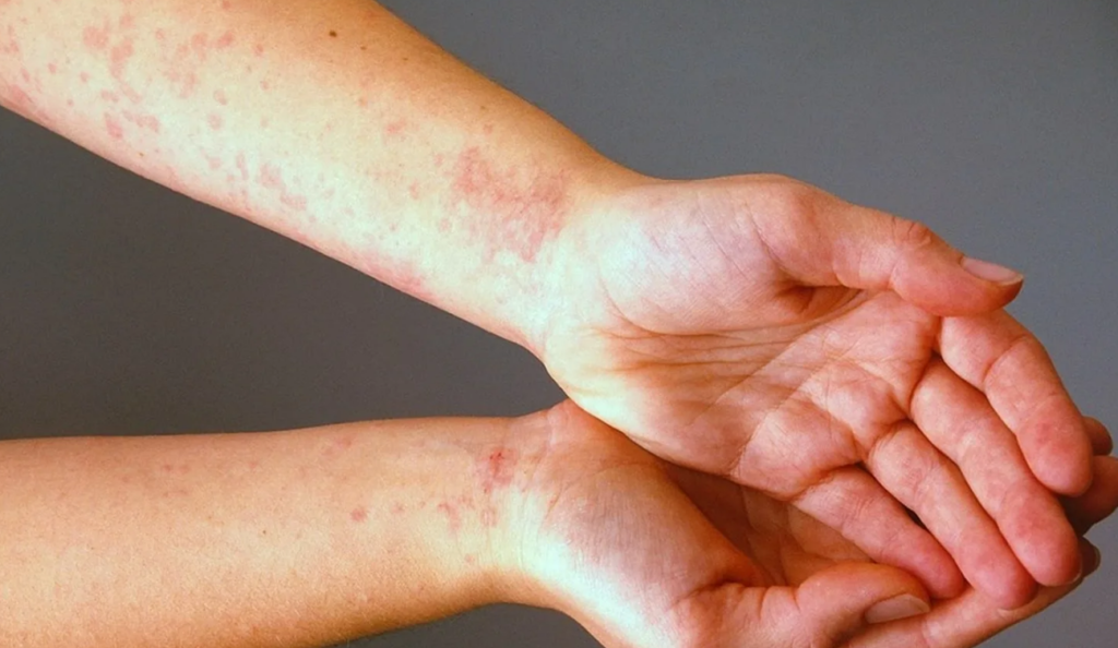 Skin Diseases