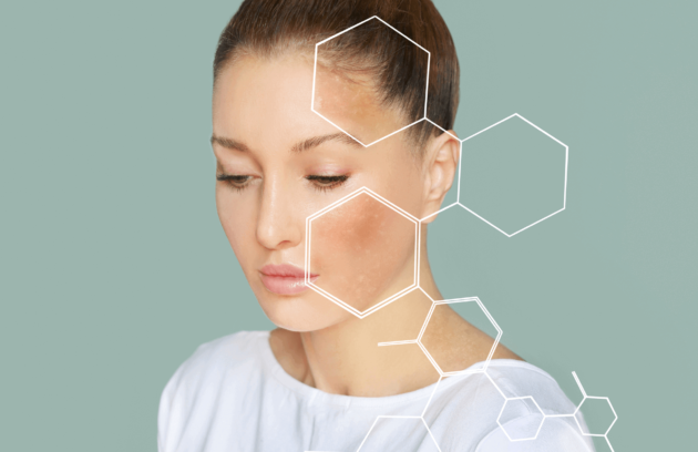 علاج الكلف بالليزر